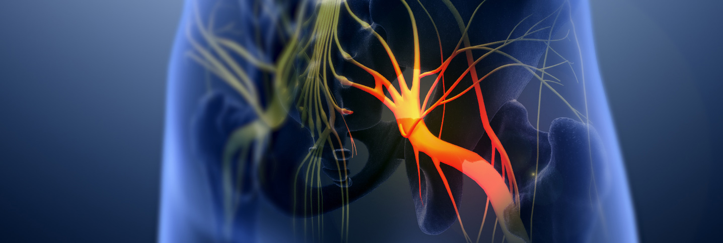 Nerve Pain